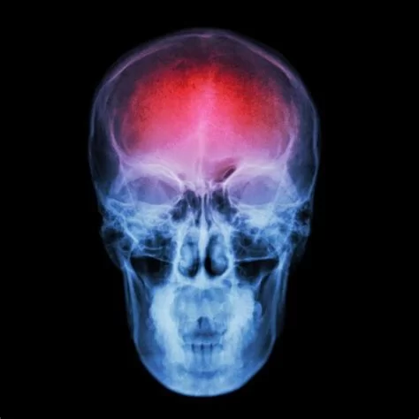 a graphic image of stroke damage to the brain in a translucent skull