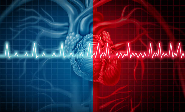 a graphic of an EEG showing the electrical disturbance in atrial fibrillation